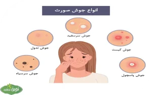 انواع جوش صورت