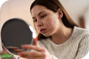 جوش صورت به دلیل بی نظمی قائدگی