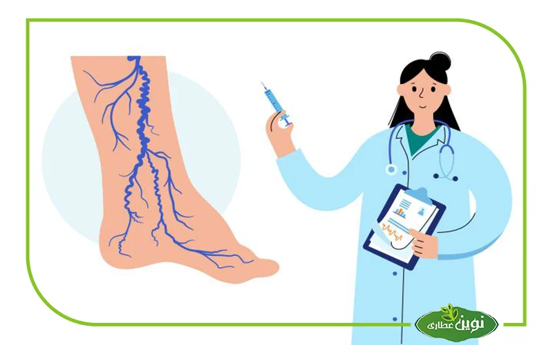 واریس چیست؟